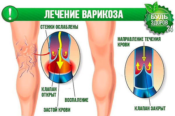 Варикоз Эффективное Народное Лечение