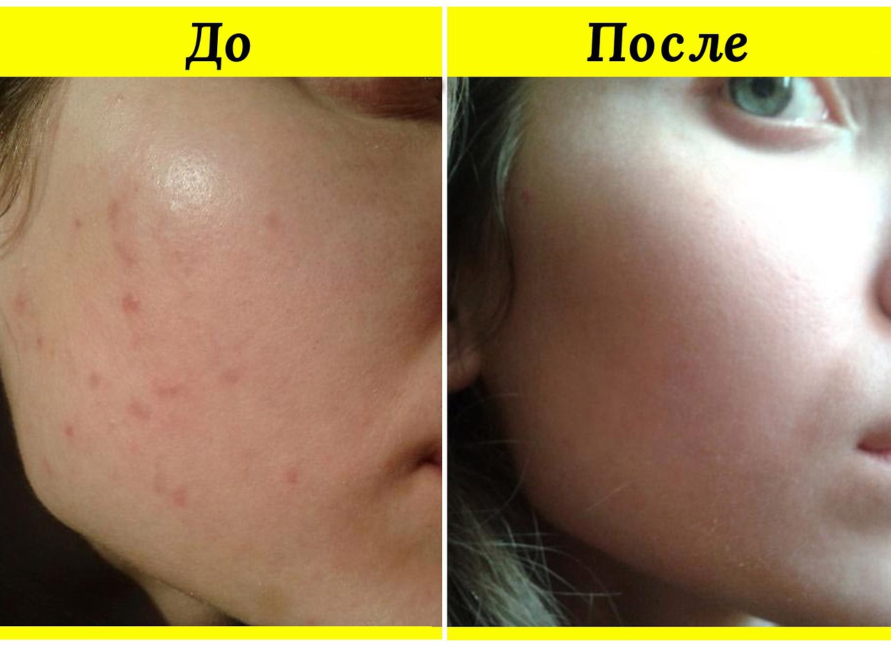 Фото Больших Прыщей