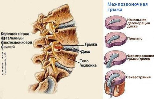 Больше полезный статей > #SPORT_здоровье@sports_is_life.Межпозвоночная грыжа позвоночника. ...