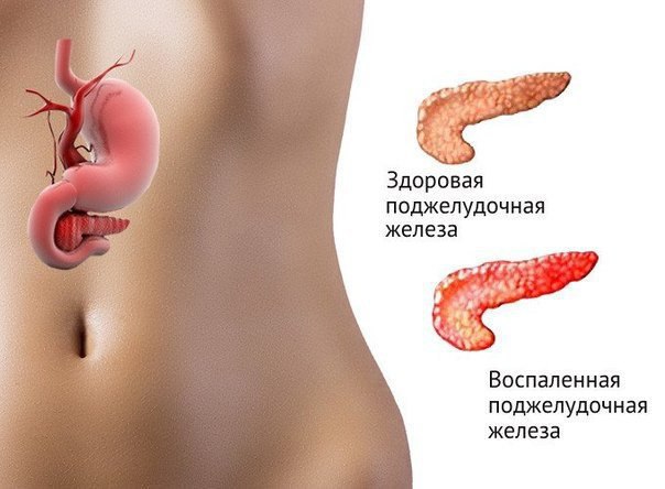 ЕСЛИ БЕСПОКОИТ ПОДЖЕЛУДОЧНАЯ ЖЕЛЕЗА. Есть способ не только облегчить страдания, но и навсегда забыть ...
