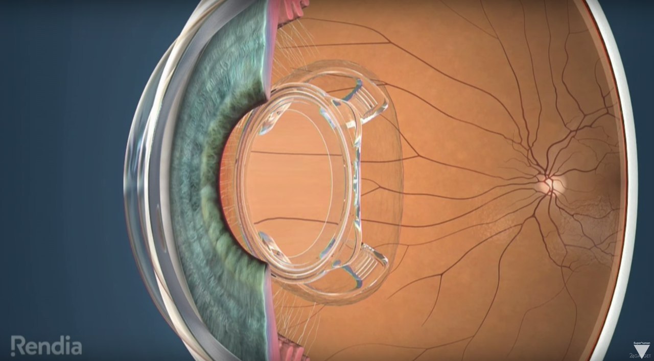    ,   .    Ocumetics ... - 2