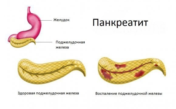 Панкреатит поджелудочной железы