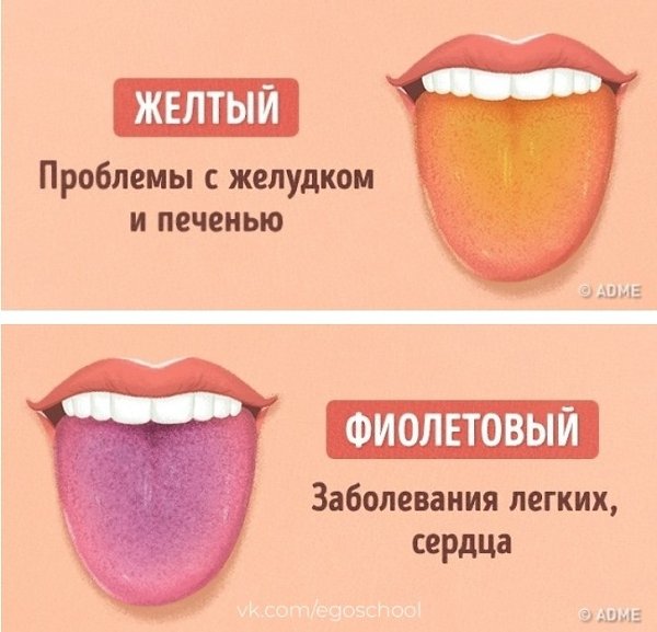 Как определить заболевание по цвету языка. На заметку - 6