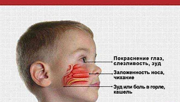 ПОСТНАЗАЛЬНЫЙ ЗАТЕК У ДЕТЕЙ.Состояние, когда избыточная слизь стекает по задней стенке глотки, ...
