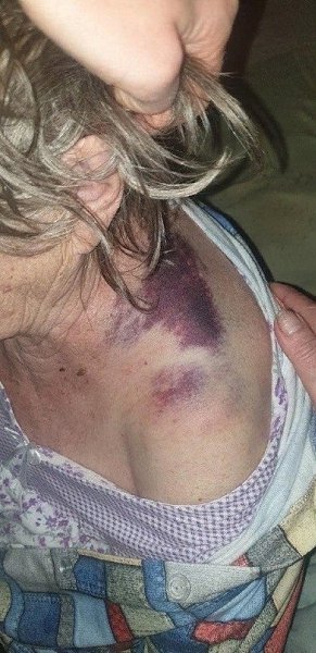 В Свердловской обл 85-летняя бабушка попала в больницу с ковидом, а выписалась с синяками и ... - 2