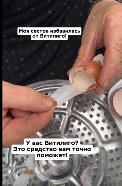 Витилиго — это кожное заболевание, которое проявляется в виде белых пятен из-за потери пигмента ...