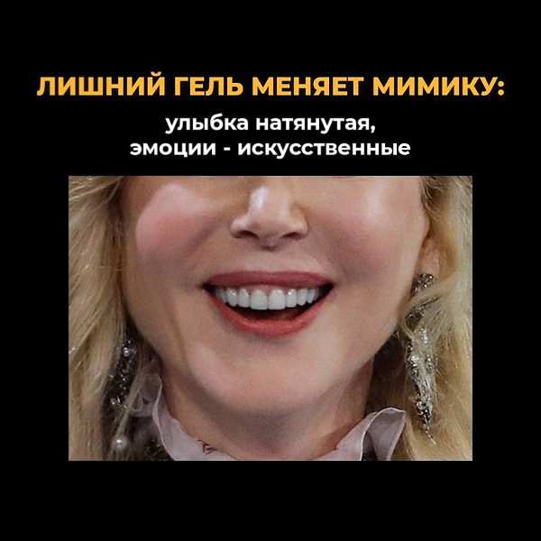 Лицо как подушка - отёки, сглаженные черты, тяжёлый взгляд. Это случается, когда филлеры используют ... - 5