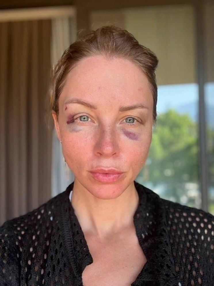 Полина Диброва показала жуткие синяки в программе Малахова.Бывшая жена Дмитрия Диброва в программе ...