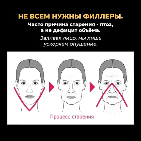 Лицо как подушка - отёки, сглаженные черты, тяжёлый взгляд. Это случается, когда филлеры используют ... - 6