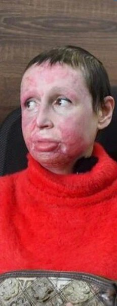 Мужчина изуродовал девушку. Избил и сжег заживо.Женщина еле спаслась от изуверской расправы, ...