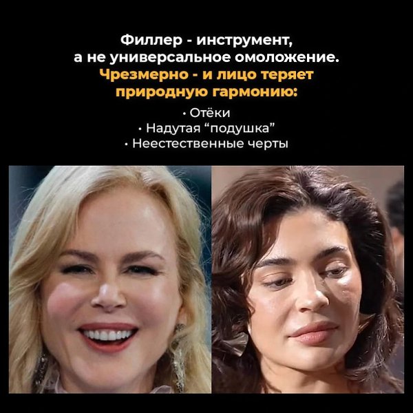 Лицо как подушка - отёки, сглаженные черты, тяжёлый взгляд. Это случается, когда филлеры используют ... - 2