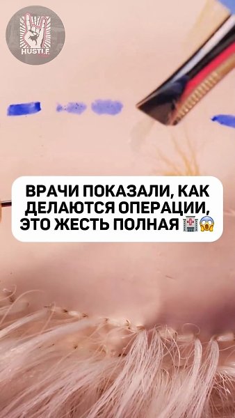 ВРАЧИ ПОКАЗАЛИ, КАК ДЕЛАЮТСЯ ОПЕРАЦИИ, ЭТО ЖЕСТЬ ПОЛНАЯ