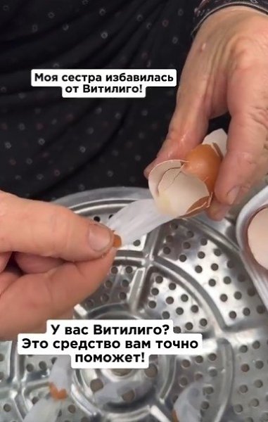 Витилиго — это кожное заболевание, которое проявляется в виде белых пятен из-за потери пигмента ... - 2